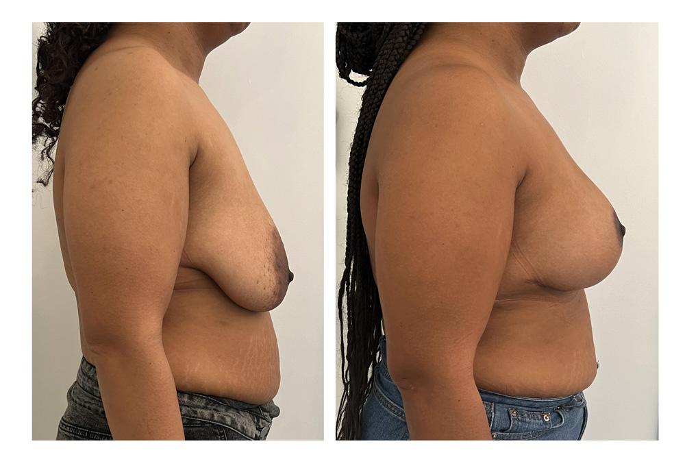 Ptose mammaire - Patient 06