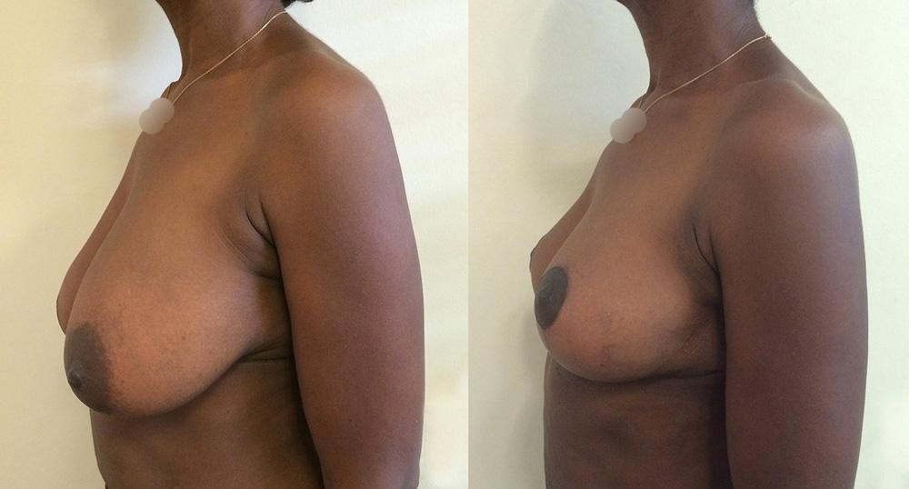 Ptose mammaire - Patient 08