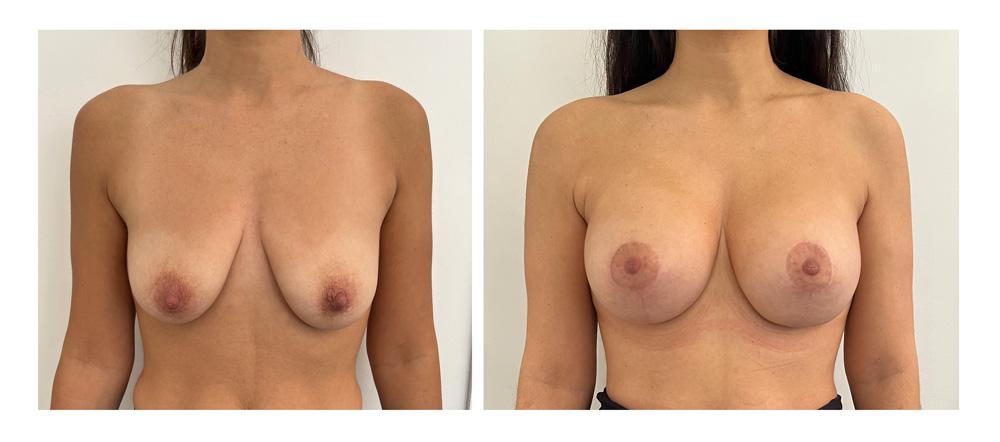 Ptose mammaire - Patient 11