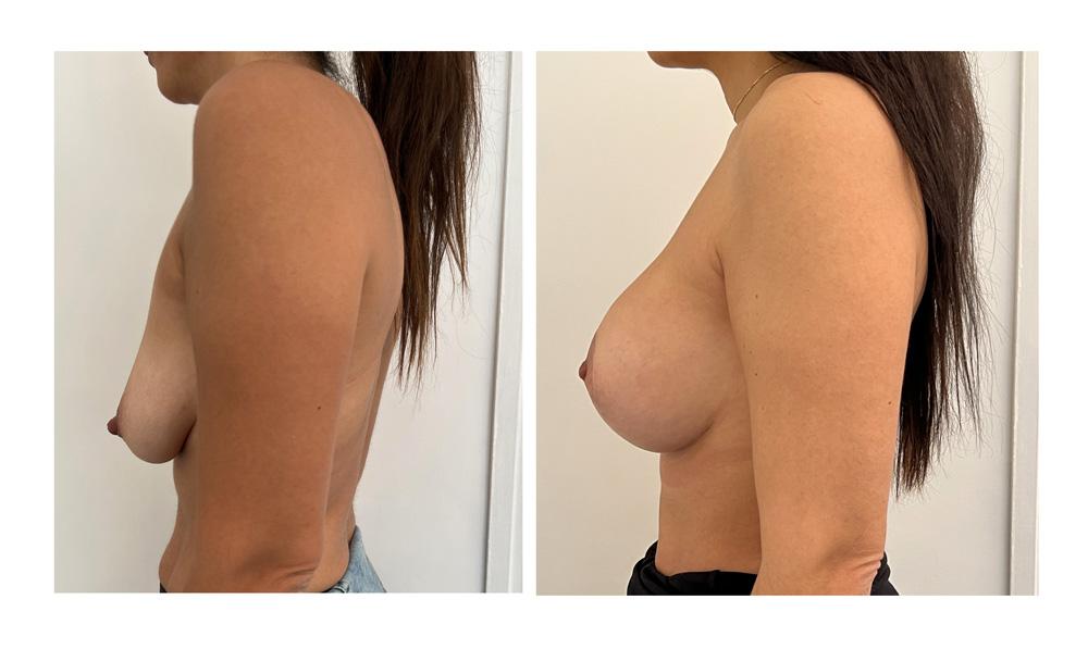 Ptose mammaire - Patient 12