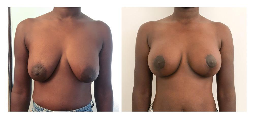 Ptose mammaire - Patient 13