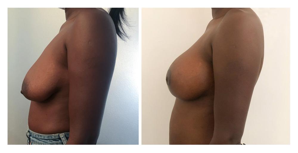 Ptose mammaire - Patient 14