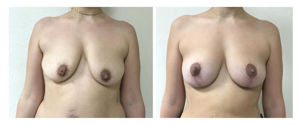 Ptose mammaire - Patient 15