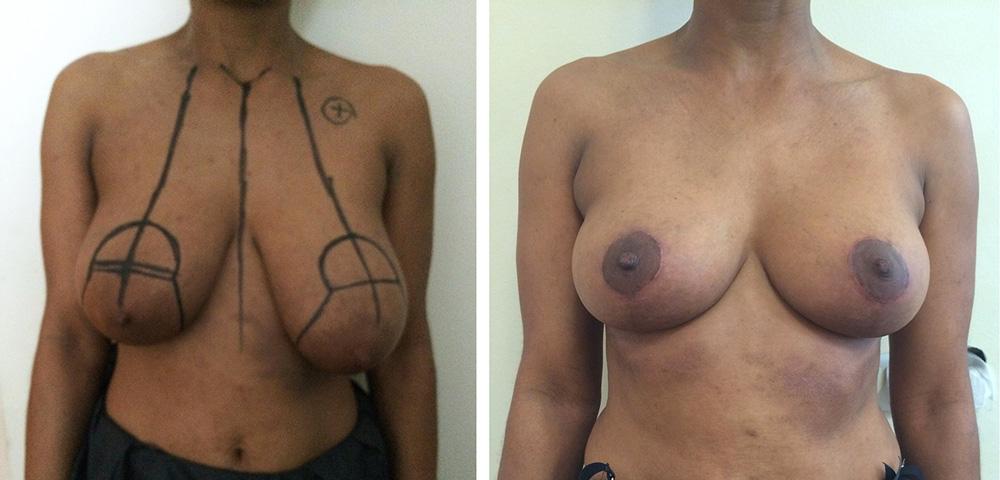 Ptose mammaire - Patient 18