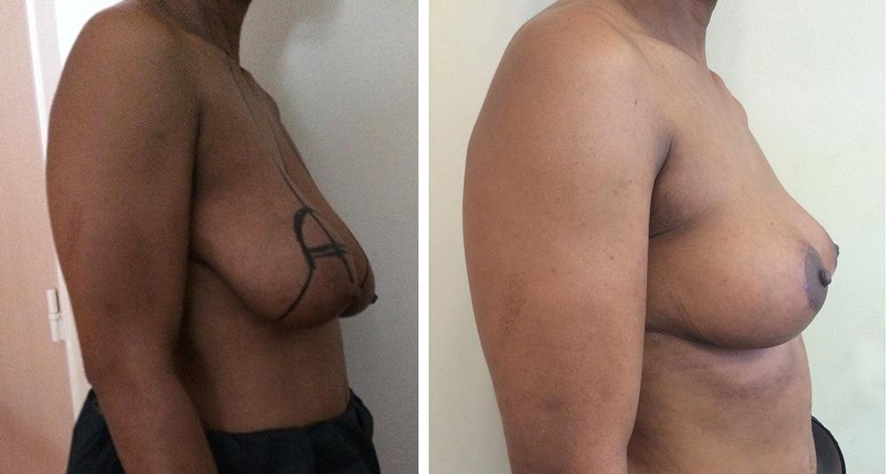 Ptose mammaire - Patient 19