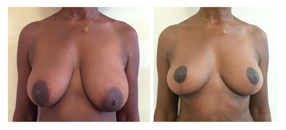 Ptose mammaire - Patient 21