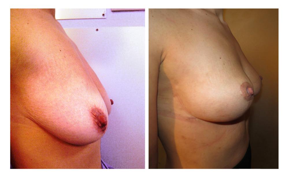 Ptose mammaire - Patient 22