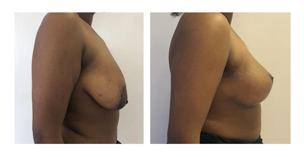 Ptose mammaire - Patient 25