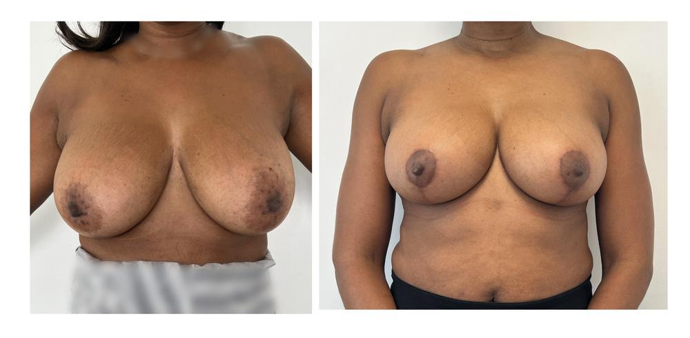R&eacute;duction mammaire - Patiente 00