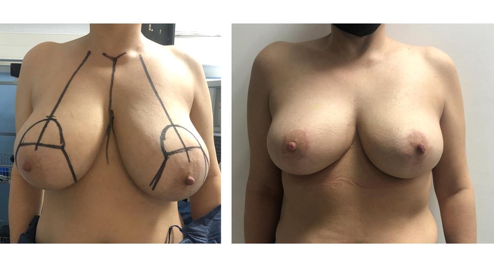 R&eacute;duction mammaire - Patiente 3