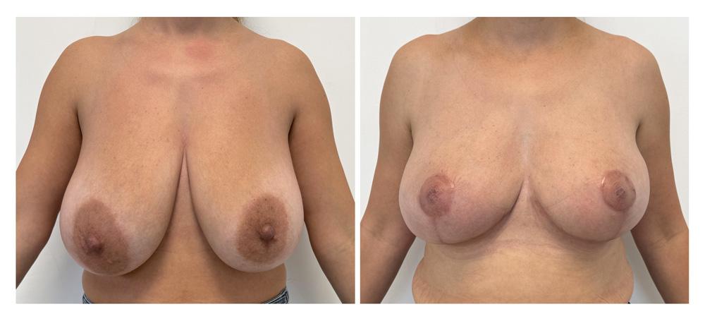 R&eacute;duction mammaire - Patiente 5