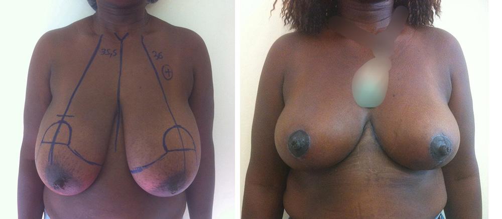 R&eacute;duction mammaire - Patiente 6