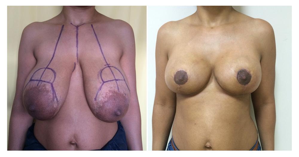 R&eacute;duction mammaire - Patiente 11