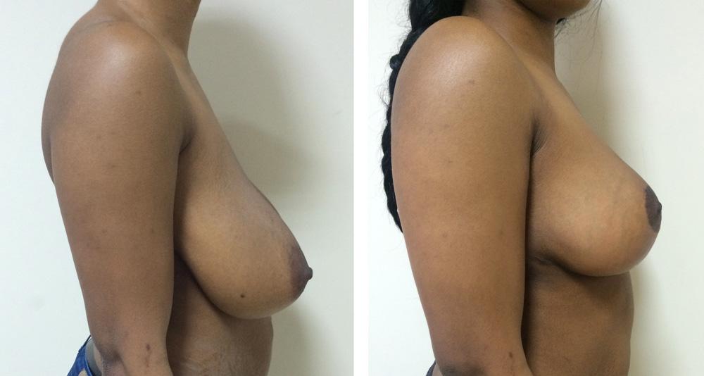 R&eacute;duction mammaire - Patiente 12