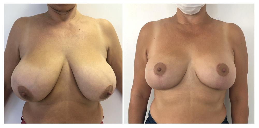 R&eacute;duction mammaire - Patiente 15