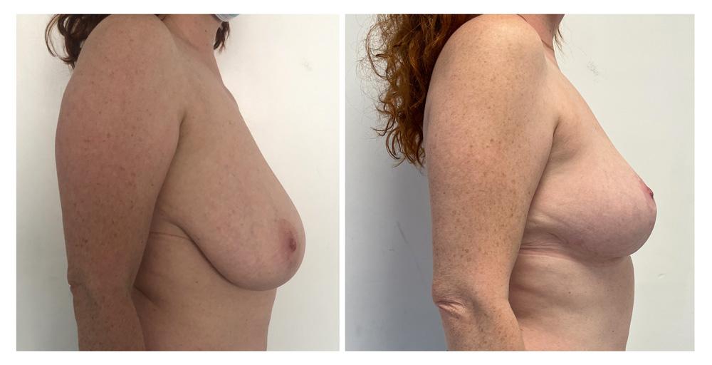 R&eacute;duction mammaire - Patiente 16