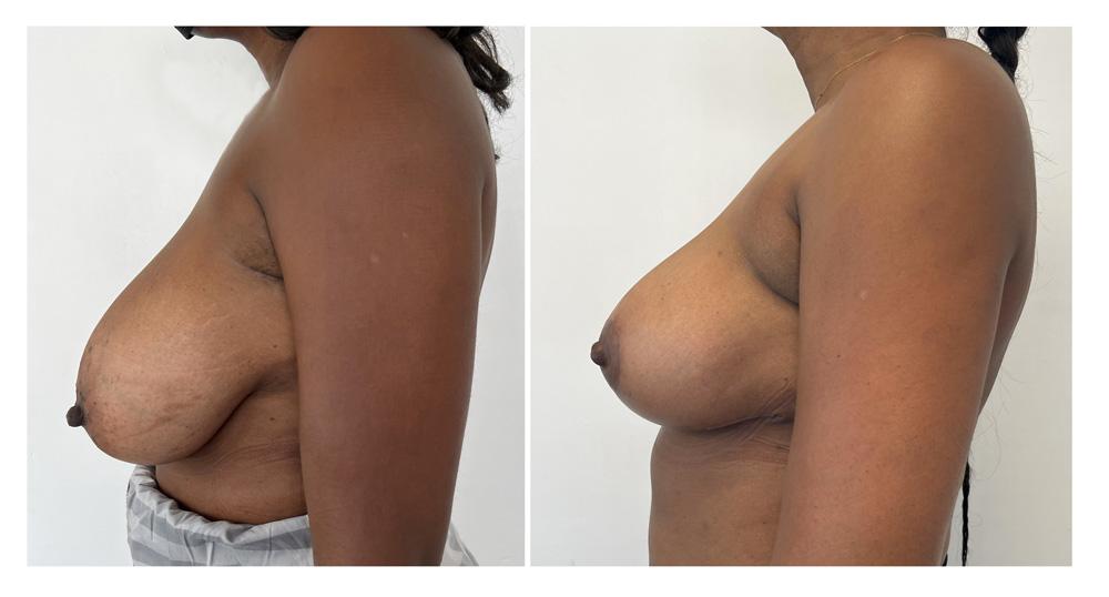 R&eacute;duction mammaire - Patiente 17